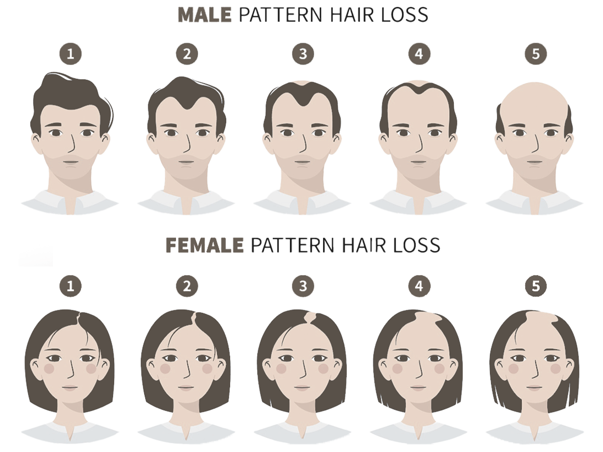 Hair Lose