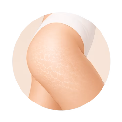 cellulite cellulite